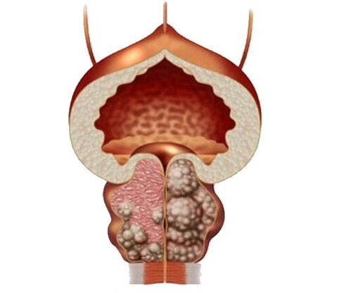Adenoma y edema de próstata y tratamiento con cápsulas UROSAF