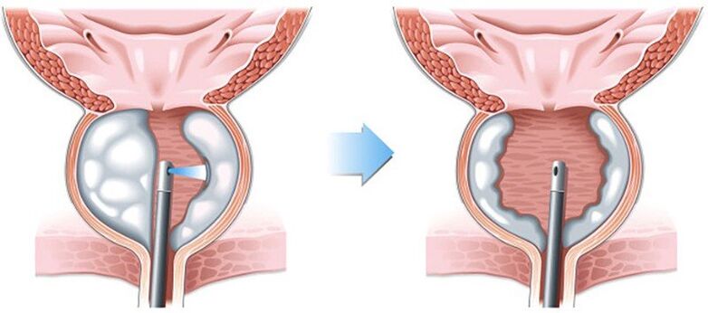 Operación de prostatitis