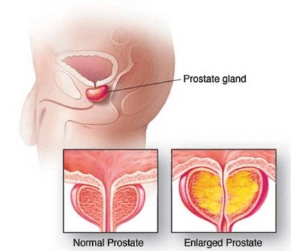 Próstata normal e inflamada