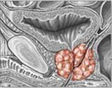 Prostatitis crónica