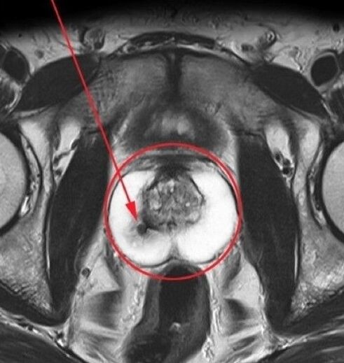 prostatitis para ultrasonido antes de tomar Urosaf